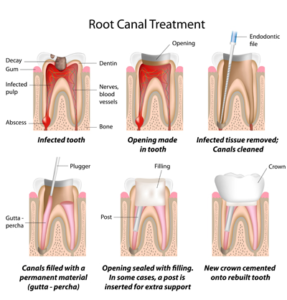Root Canals in Richmond, VA