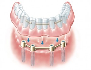 full denture two