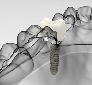 dental implants richmond va