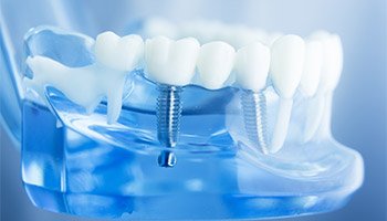 Dental Implants 9220 Forest Hill Avenue, Richmond