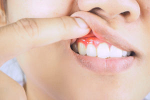 why you need to treat gum disease now