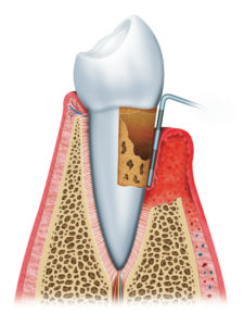 Root Canal Diagram