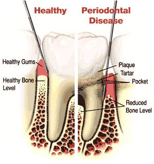 diagram depicting the effects of gum disease