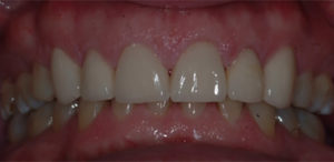 our patient smiling after their cosmetic dentistry procedure
