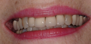 our patient's smile before her dental crowns procedure