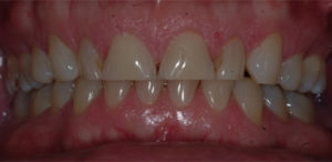 our patient smiling before their dental crowns procedure