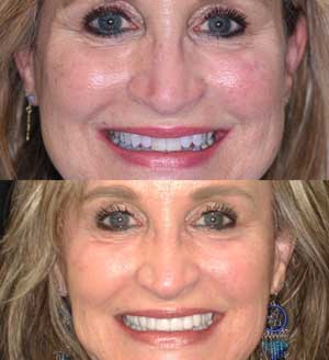 full face transformation
